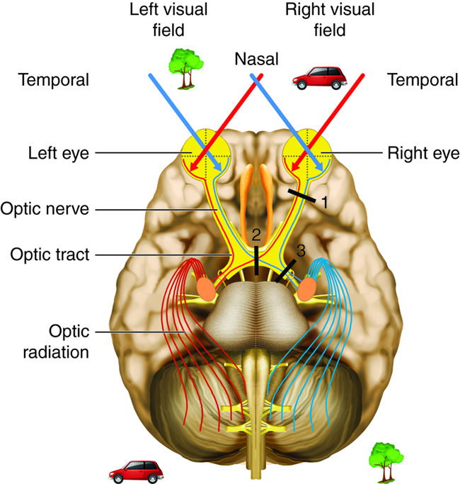 Depiction of how visual information has sidedness in the brain. The diagram shows how information from the right visual field is delivered to the left brain and how information from the left visual field is delivered to the right side of the brain.