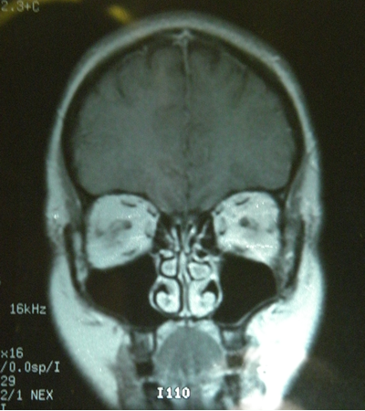 Anterior Brain MRI