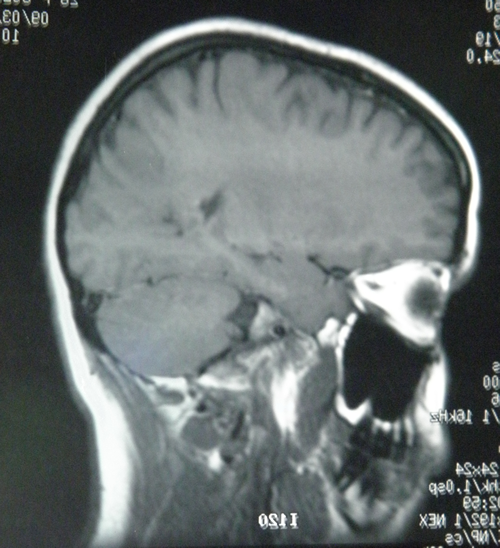 Lateral Brain MRI
