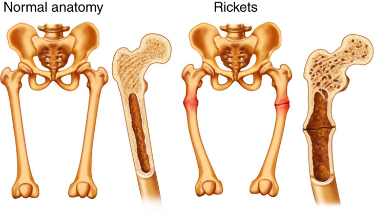 Normal anatomy vs. Rickets