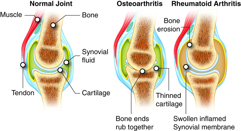 Normal joint v. Osteoarthritis v. Rheumatoid arthritis