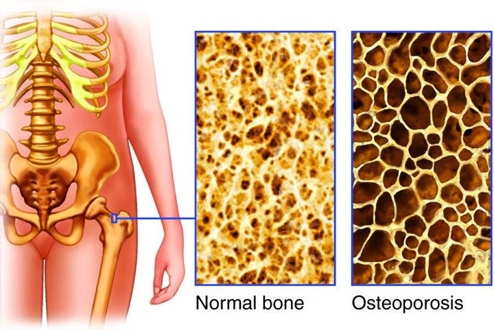 Normal bone v. Osteoporosis