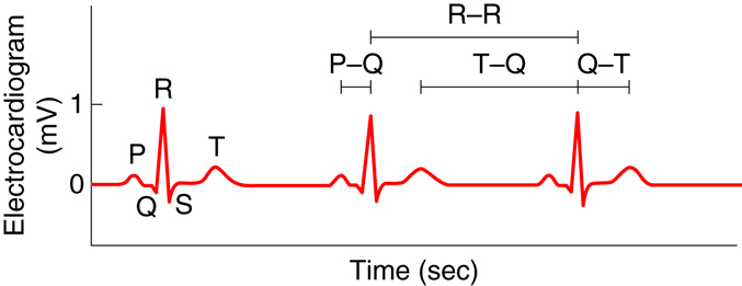 ECG trace with the component waves labeled