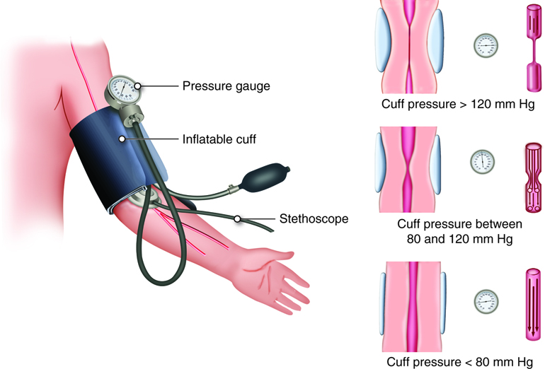 Measurement of blood pressure with a sphygmomanometer and stethoscope