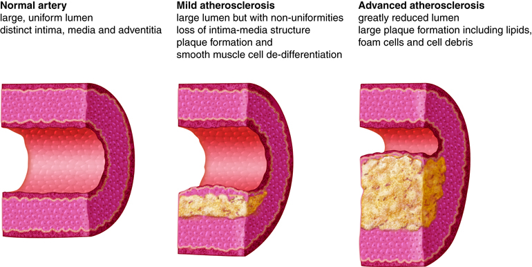 Progression of atherosclerosis